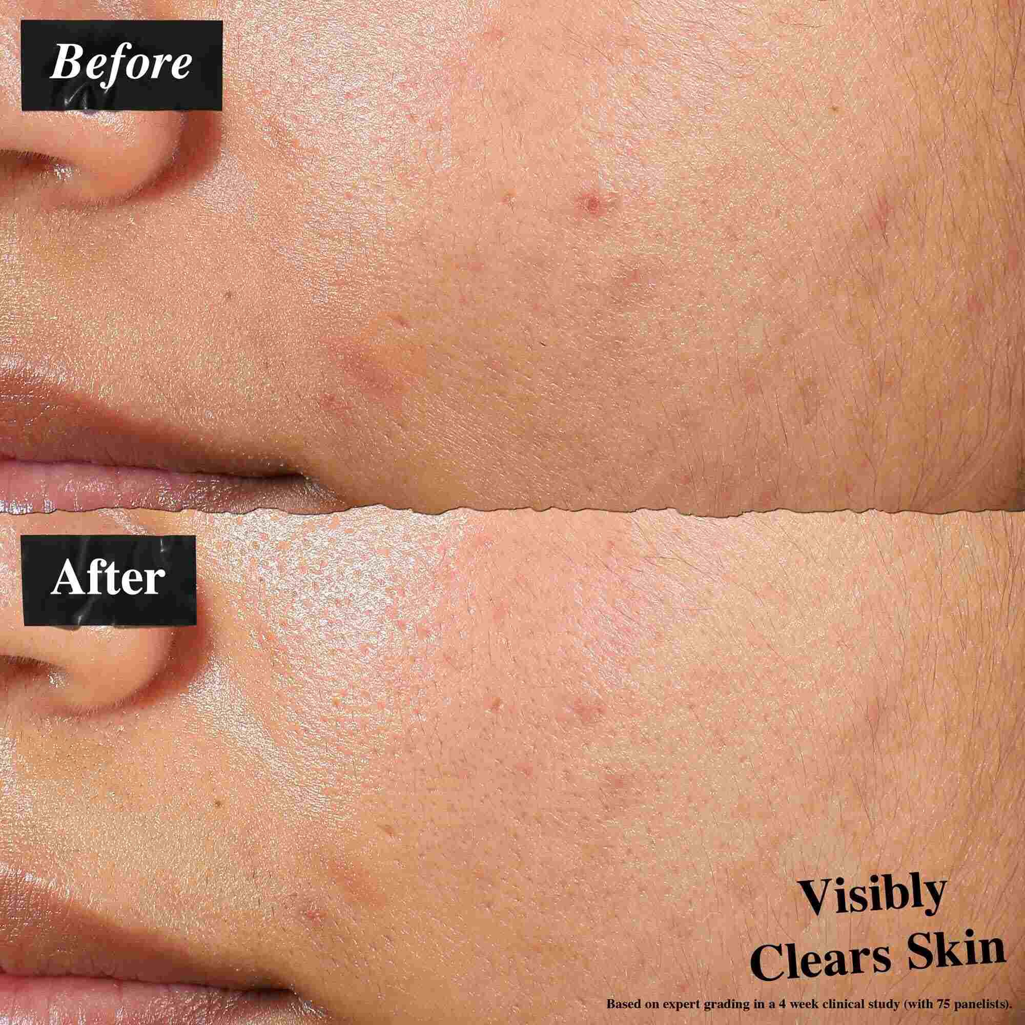 A before-and-after comparison showing skin treated with Expertly Clear Blemish-Treating & Preventing Lotion. The "before" image shows blemishes and uneven skin texture, while the "after" image shows visibly clearer skin.