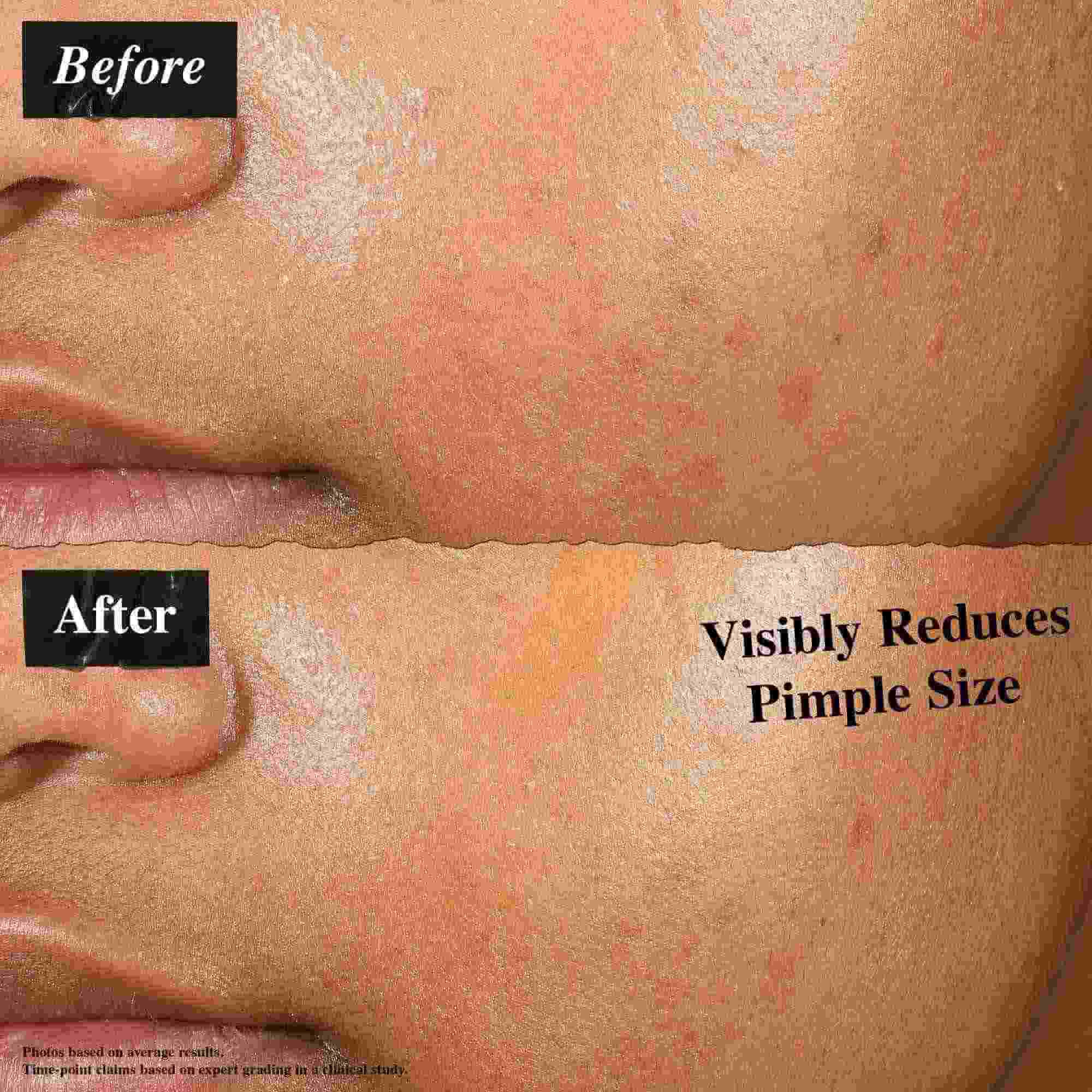 A before-and-after comparison showing skin treated with Truly-Targeted Blemish-Clearing Solution. The 'before' image shows visible pimples, while the 'after' image shows reduced pimple size.