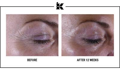 Super Multi-Corrective Eye Zone Treatment Oncesi ve Sonrası