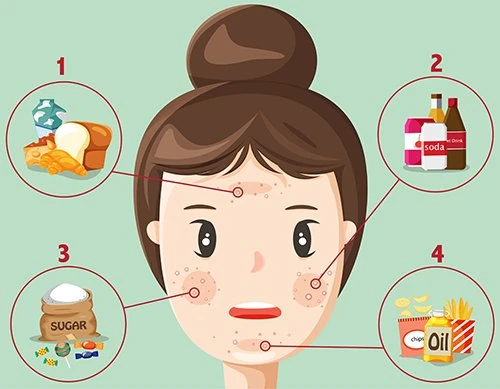 https://www.kiehls.com.tr/media/kiehls_blog_images/19-07/30/akne-olusumuna-neden-olan-yiyecekler.webp
